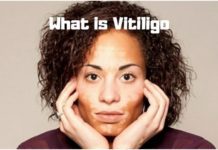 What is Vitiligo- What causes Vitiligo