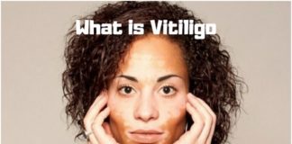 What is Vitiligo- What causes Vitiligo