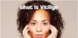 What is Vitiligo- What causes Vitiligo