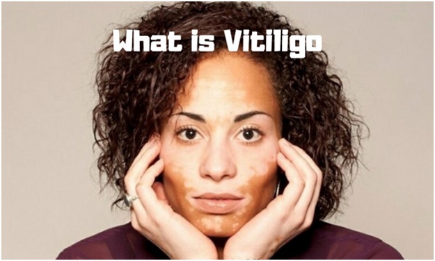 What is Vitiligo- What causes Vitiligo