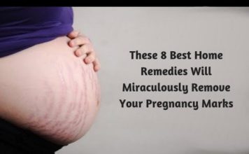These 8 Best Home Remedies Will Miraculously Remove Your Pregnancy Marks