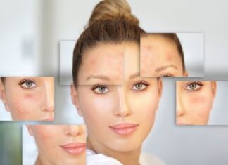 Find the Acne Medication for Your Needs