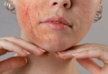 rosacea-proof your skincare picking the perfect moisturiser