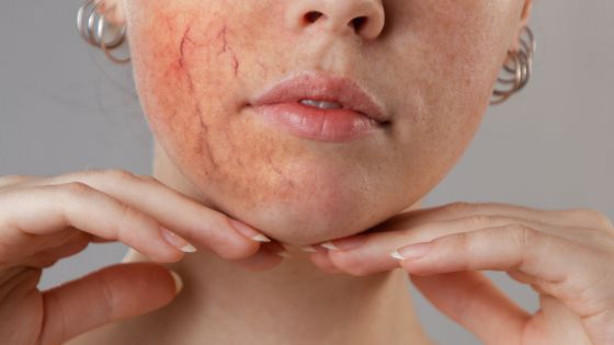 rosacea-proof your skincare picking the perfect moisturiser