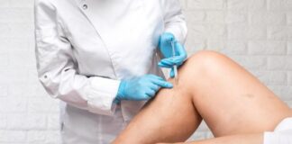 finding relief a guide to varicose vein treatment