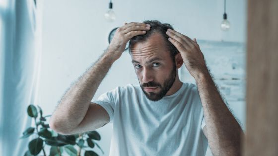 causes of hair loss and baldness in men